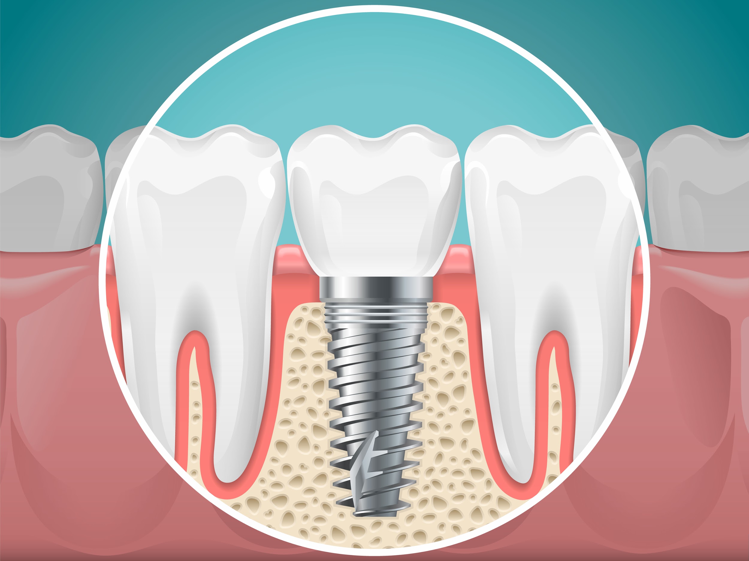 Dental Implants Cost Brisbane | Affordable Missing Teeth Solution