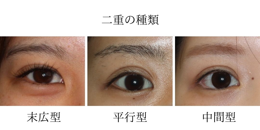自然な二重まぶたの作り方 - 理想に近づくためのポイントと技術